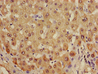 Immunohistochemistry of paraffin-embedded human liver tissue using ADH1B Antibody at dilution of 1:100Rabbit anti-Human ADH1B Polyclonal Antibody
