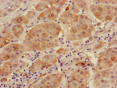 Immunohistochemistry of paraffin-embedded human liver cancer using ADH1B Antibody at dilution of 1:100Rabbit anti-Human ADH1B Polyclonal Antibody