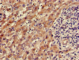 Immunohistochemistry of paraffin-embedded human liver cancer using ADH5 Antibody at dilution of 1:100Rabbit anti-Human ADH5 Polyclonal Antibody