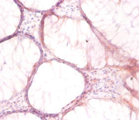 Immunohistochemistry of paraffin-embedded human colon cancer using ATP6V1G1 Antibody at dilution of 1:50