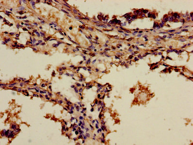 Immunohistochemistry of paraffin-embedded human lung cancer using ADH7 Antibody at dilution of 1:100Rabbit anti-Human ADH7 Polyclonal Antibody
