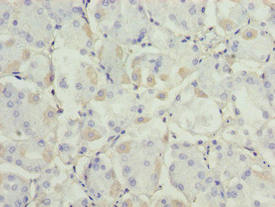Immunohistochemistry of paraffin-embedded human gastric cancer using ADH7 Antibody at dilution of 1:100Rabbit anti-Human ADH7 Polyclonal Antibody