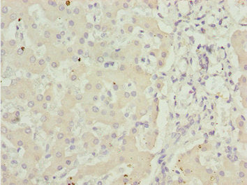Immunohistochemistry of paraffin-embedded human liver tissue using ADPGK Antibody at dilution of 1:100Rabbit anti-Human ADPGK Polyclonal Antibody