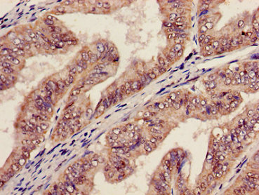 Immunohistochemistry of paraffin-embedded human endometrial cancer using AGPAT5 Antibody at dilution of 1:100Rabbit anti-Human AGPAT5 Polyclonal Antibody