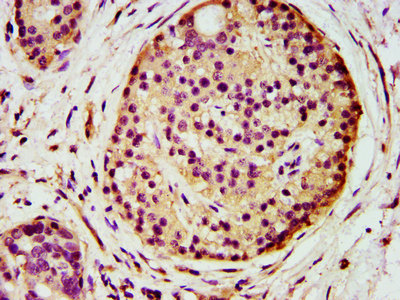 IHC image of AGPS Antibody diluted at 1:500 and staining in paraffin-embedded human pancreatic cancer performed on a Leica BondTM system. After dewaxing and hydration, antigen retrieval was mediated by high pressure in a citrate buffer (pH 6.0). Section was blocked with 10% normal goat serum 30min at RT. Then primary antibody (1% BSA) was incubated at 4°C overnight. The primary is detected by a biotinylated secondary antibody and visualized using an HRP conjugated SP system.Rabbit anti-Human AGPS Polyclonal Antibody