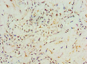 Immunohistochemistry of paraffin-embedded human breast cancer using the antibody at dilution of 1:100Rabbit anti-Human AGR2 Polyclonal Antibody