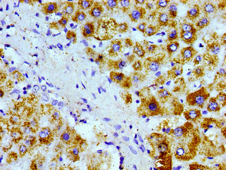 Immunohistochemistry of paraffin-embedded human liver tissue using AGXT Antibody at dilution of 1:100Rabbit anti-Human AGXT Polyclonal Antibody
