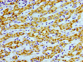 Immunohistochemistry of paraffin-embedded human liver cancer using AGXT Antibody at dilution of 1:100Rabbit anti-Human AGXT Polyclonal Antibody