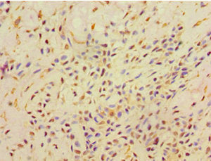 Immunohistochemistry of paraffin-embedded human breast cancer using AHCYL1 Antibody at dilution of 1:100