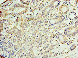 Immunohistochemistry of paraffin-embedded human breast cancer using AKAP10 Antibody at dilution of 1:100Rabbit anti-Human AKAP10 Polyclonal Antibody