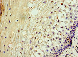 Immunohistochemistry of paraffin-embedded human cervical cancer using AKAP10 Antibody at dilution of 1:100Rabbit anti-Human AKAP10 Polyclonal Antibody