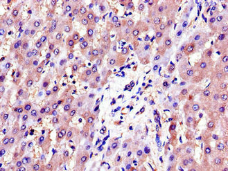 Immunohistochemistry of paraffin-embedded human liver tissue using AKR1B1 Antibody at dilution of 1:100Rabbit anti-Human AKR1B1 Polyclonal Antibody