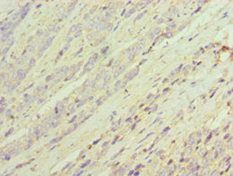 Immunohistochemistry of paraffin-embedded human colon cancer using AKR1C3 Antibody at dilution of 1:100Rabbit anti-Human AKR1C3 Polyclonal Antibody