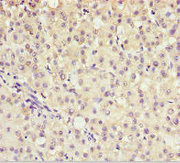 Immunohistochemistry of paraffin-embedded human liver cancer using AKR7A2 Antibody at dilution of 1:100Rabbit anti-Human AKR7A2 Polyclonal Antibody