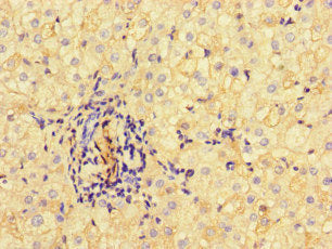 Immunohistochemistry of paraffin-embedded human liver cancer using ALB Antibody at dilution of 1:100Rabbit anti-Human ALB Polyclonal Antibody