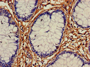 Immunohistochemistry of paraffin-embedded human colon cancer using ALDH1A2 Antibody at dilution of 1:100Rabbit anti-Human ALDH1A2 Polyclonal Antibody