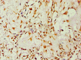 Immunohistochemistry of paraffin-embedded human breast cancer using ALDH1B1 Antibody at dilution of 1:100Rabbit anti-Human ALDH1B1 Polyclonal Antibody