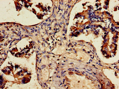 Immunohistochemistry of paraffin-embedded human lung tissue using ALDH3A1 Antibody at dilution of 1:100Rabbit anti-Human ALDH3A1 Polyclonal Antibody