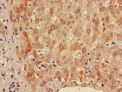 Immunohistochemistry of paraffin-embedded human liver tissue using ALDH3A1 Antibody at dilution of 1:100Rabbit anti-Human ALDH3A1 Polyclonal Antibody