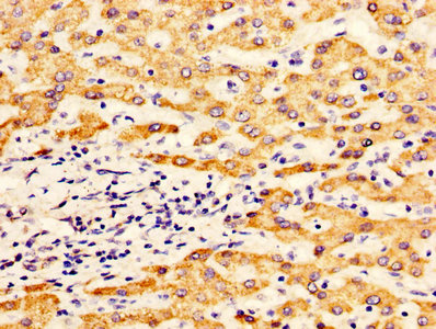 IHC image of ALDH5A1 Antibody diluted at 1:400 and staining in paraffin-embedded human liver cancer performed on a Leica BondTM system. After dewaxing and hydration, antigen retrieval was mediated by high pressure in a citrate buffer (pH 6.0). Section was blocked with 10% normal goat serum 30min at RT. Then primary antibody (1% BSA) was incubated at 4°C overnight. The primary is detected by a biotinylated secondary antibody and visualized using an HRP conjugated SP system.Rabbit anti-Human ALDH5A1 Polyclonal Antibody