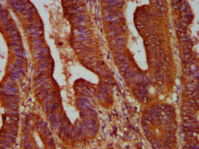IHC image of ALOX12 Antibody diluted at 1:500 and staining in paraffin-embedded human colon cancer performed on a Leica BondTM system. After dewaxing and hydration, antigen retrieval was mediated by high pressure in a citrate buffer (pH 6.0). Section was blocked with 10% normal goat serum 30min at RT. Then primary antibody (1% BSA) was incubated at 4°C overnight. The primary is detected by a biotinylated secondary antibody and visualized using an HRP conjugated SP system.Rabbit anti-Human ALOX12 Polyclonal Antibody