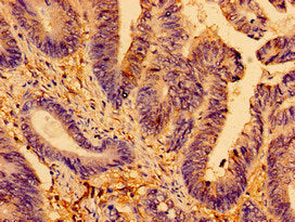 Immunohistochemistry of paraffin-embedded human colon cancer using the antibody at dilution of 1:100Rabbit anti-Human AMPD2 Polyclonal Antibody