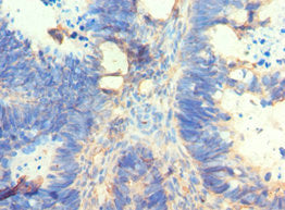 Immunohistochemistry of paraffin-embedded human ovarian cancer using AMY2A Antibody at dilution of 1:100Rabbit anti-Human AMY2A Polyclonal Antibody