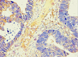 Immunohistochemistry of paraffin-embedded human ovarian cancer using AMY2B Antibody at dilution of 1:100Rabbit anti-Human AMY2B Polyclonal Antibody