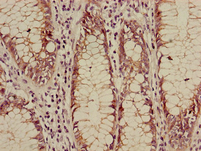 Immunohistochemistry of paraffin-embedded human colon cancer using CTNNB1 Antibody at dilution of 1:100Rabbit anti-Human CTNNB1 Polyclonal Antibody