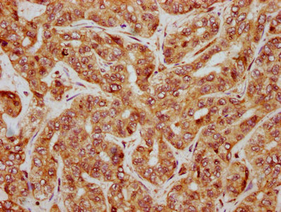 IHC image of CTNNB1 Antibody diluted at 1:500 and staining in paraffin-embedded human liver cancer performed on a Leica BondTM system. After dewaxing and hydration, antigen retrieval was mediated by high pressure in a citrate buffer (pH 6.0). Section was blocked with 10% normal goat serum 30min at RT. Then primary antibody (1% BSA) was incubated at 4°C overnight. The primary is detected by a biotinylated secondary antibody and visualized using an HRP conjugated SP system.Rabbit anti-Human CTNNB1 Polyclonal Antibody