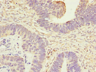 Immunohistochemistry of paraffin-embedded human ovarian cancer using ANTXR2 Antibody at dilution of 1:100Rabbit anti-Human ANTXR2 Polyclonal Antibody