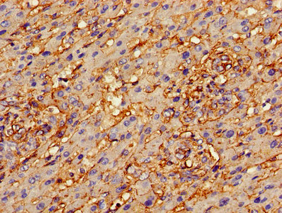 Immunohistochemistry of paraffin-embedded human liver cancer using ANXA2 Antibody at dilution of 1:100Rabbit anti-Human ANXA2 Polyclonal Antibody