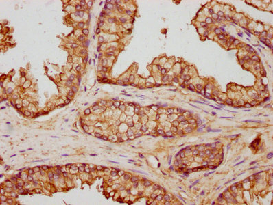 IHC image of ANXA5 Antibody diluted at 1:500 and staining in paraffin-embedded human prostate cancer performed on a Leica BondTM system. After dewaxing and hydration, antigen retrieval was mediated by high pressure in a citrate buffer (pH 6.0). Section was blocked with 10% normal goat serum 30min at RT. Then primary antibody (1% BSA) was incubated at 4°C overnight. The primary is detected by a biotinylated secondary antibody and visualized using an HRP conjugated SP system.Rabbit anti-Human ANXA5 Polyclonal Antibody