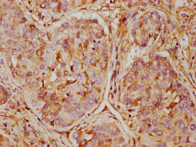 IHC image of ANXA5 Antibody diluted at 1:500 and staining in paraffin-embedded human liver cancer performed on a Leica BondTM system. After dewaxing and hydration, antigen retrieval was mediated by high pressure in a citrate buffer (pH 6.0). Section was blocked with 10% normal goat serum 30min at RT. Then primary antibody (1% BSA) was incubated at 4°C overnight. The primary is detected by a biotinylated secondary antibody and visualized using an HRP conjugated SP system.Rabbit anti-Human ANXA5 Polyclonal Antibody