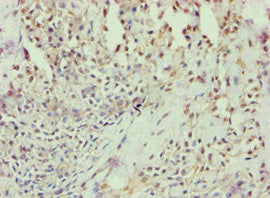 Immunohistochemistry of paraffin-embedded human breast cancer using ANXA7 Antibody at dilution of 1:100Rabbit anti-Human ANXA7 Polyclonal Antibody