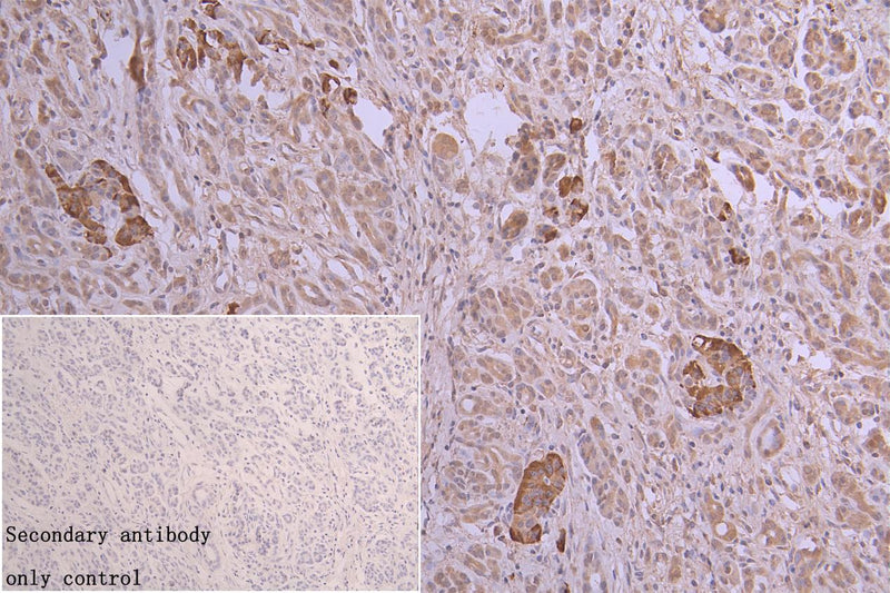 Immunohistochemistry of paraffin-embedded human pancreatic cancer using AOAH Antibody at dilution of 1:100Rabbit anti-Human AOAH Polyclonal Antibody