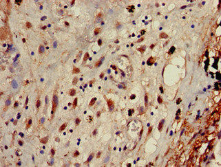 Immunohistochemistry of paraffin-embedded human lung cancer using AP1G1 Antibody at dilution of 1:100Rabbit anti-Human AP1G1 Polyclonal Antibody