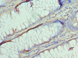 Immunohistochemistry of paraffin-embedded human colon cancer using AP2B1 Antibody at dilution of 1:100Rabbit anti-Human AP2B1 Polyclonal Antibody