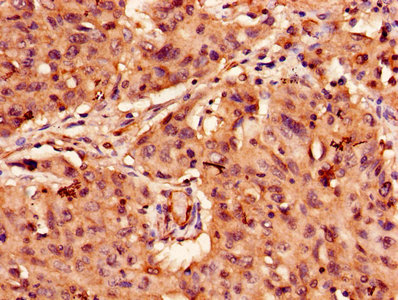 Immunohistochemistry of paraffin-embedded human lung cancer using APAF1 Antibody at dilution of 1:100Rabbit anti-Human APAF1 Polyclonal Antibody