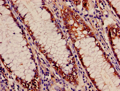 Immunohistochemistry of paraffin-embedded human colon cancer using APEH Antibody at dilution of 1:100Rabbit anti-Human APEH Polyclonal Antibody