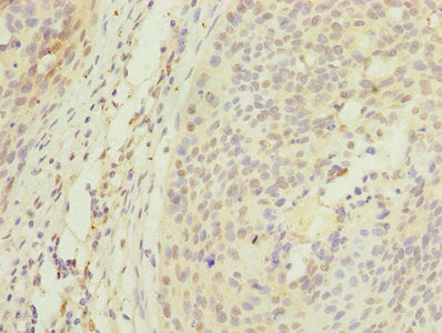 Immunohistochemistry of paraffin-embedded human cervical cancer using APEX1 Antibody at dilution of 1:100Rabbit anti-Human APEX1 Polyclonal Antibody