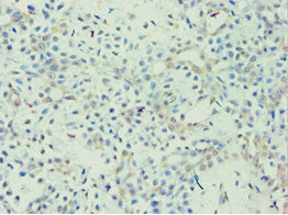 Immunohistochemistry of paraffin-embedded human breast cancer using APOL1 Antibody at dilution of 1:100Rabbit anti-Human APOL1 Polyclonal Antibody