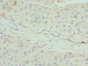 Immunohistochemistry of paraffin-embedded human liver cancer using APOM Antibody at dilution of 1:100