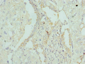 Immunohistochemistry of paraffin-embedded human lung cancer using APOM Antibody at dilution of 1:100