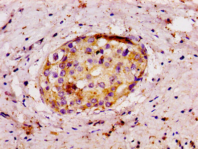 IHC image of APP Antibody diluted at 1:100 and staining in paraffin-embedded human breast cancer performed on a Leica BondTM system. After dewaxing and hydration, antigen retrieval was mediated by high pressure in a citrate buffer (pH 6.0). Section was blocked with 10% normal goat serum 30min at RT. Then primary antibody (1% BSA) was incubated at 4°C overnight. The primary is detected by a biotinylated secondary antibody and visualized using an HRP conjugated SP system.Rabbit anti-Human APP Polyclonal Antibody