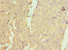 Immunohistochemistry of paraffin-embedded human colon cancer using NAA10 Antibody at dilution of 1:100Rabbit anti-Human NAA10 Polyclonal Antibody