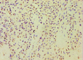 Immunohistochemistry of paraffin-embedded human breast cancer using ARF3 Antibody at dilution of 1:100Rabbit anti-Human ARF3 Polyclonal Antibody