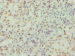 Immunohistochemistry of paraffin-embedded human breast cancer using ARF6 Antibody at dilution of 1:100Rabbit anti-Human ARF6 Polyclonal Antibody