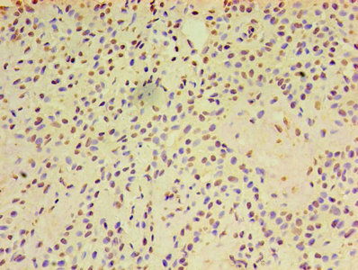 Immunohistochemistry of paraffin-embedded human breast cancer using the antibody at dilution of 1:100Rabbit anti-Human ARF6 Polyclonal Antibody
