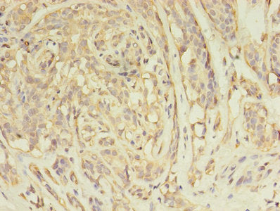 Immunohistochemistry of paraffin-embedded human breast cancer using ARFIP2 Antibody at dilution of 1:100Rabbit anti-Human ARFIP2 Polyclonal Antibody